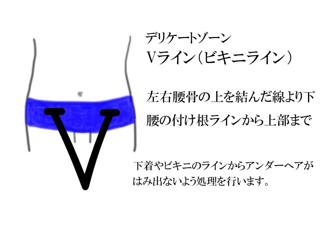 vio脱毛